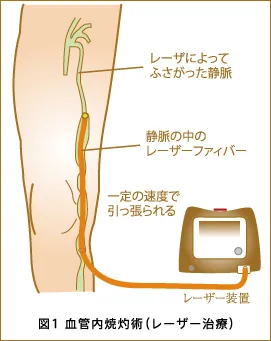 血管内焼灼術