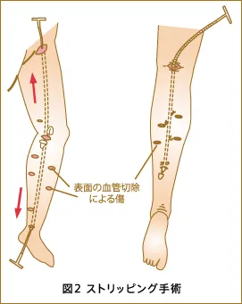 ストリッピング術