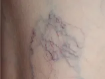 クモの巣状静脈瘤