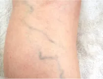 網目状静脈瘤