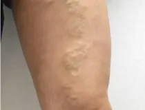 分枝型静脈瘤