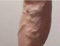 伏在型静脈瘤