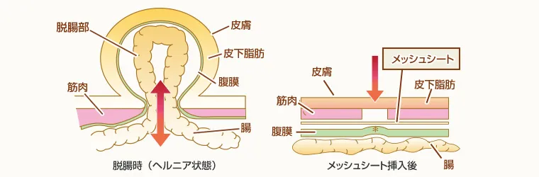 そけいヘルニアの治療方法
