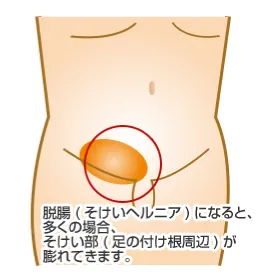 そけいヘルニア外部図