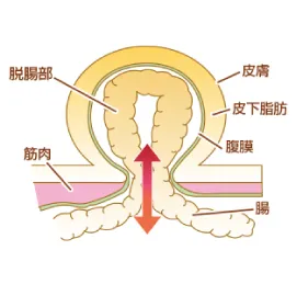 そけいヘルニア内部断面図